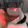 Tto. de Fototerapia Peeling